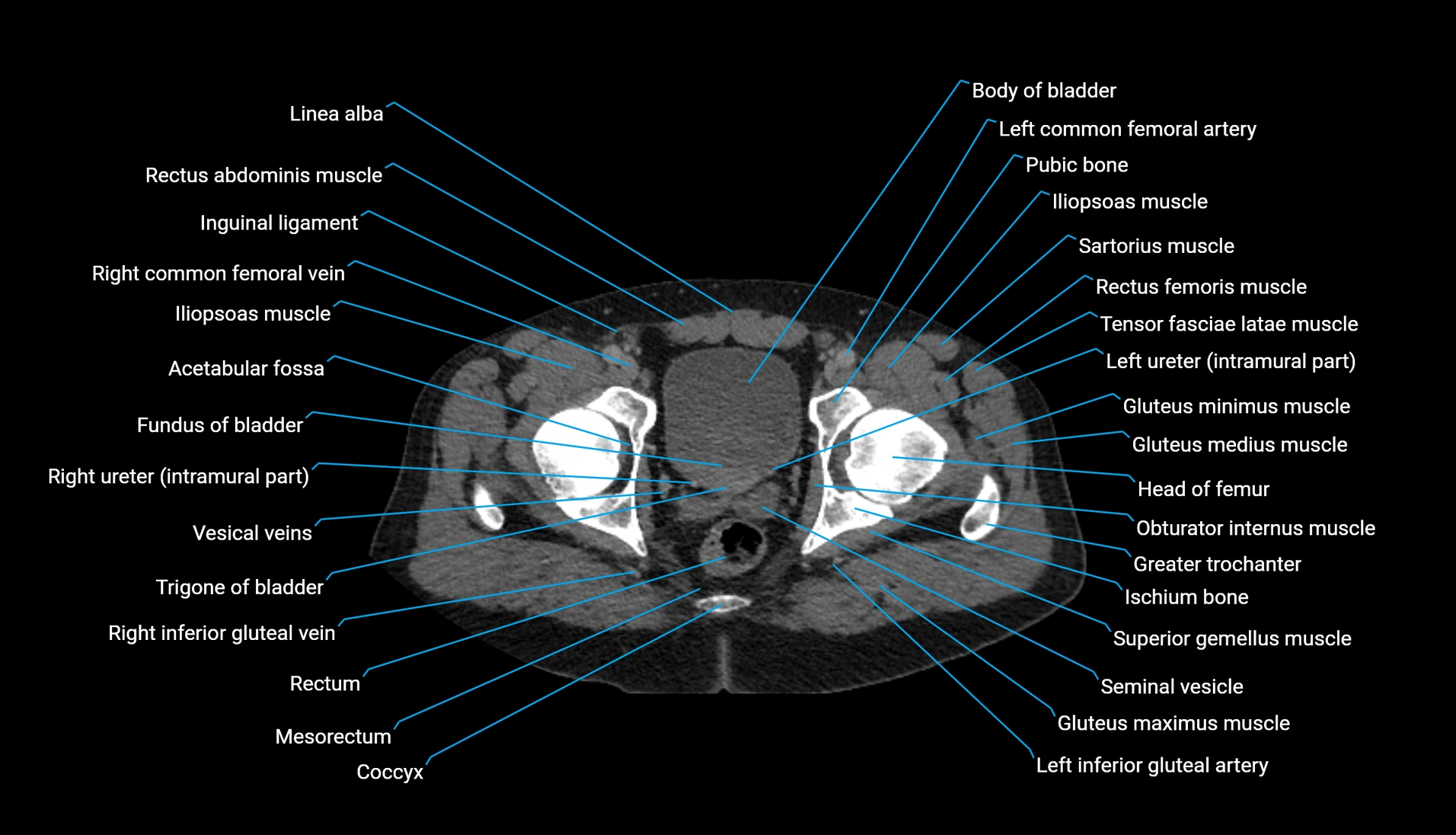 CT urogram axial cross sectional anatomy  labelled radiology image-00233.webp